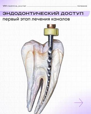 Эндодонтический доступ: 80% успеха лечения каналов.